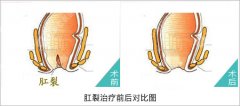 肛裂是什么引起的