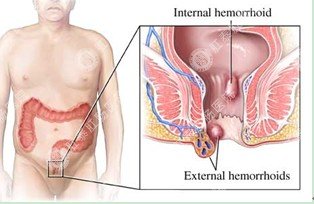 痔疮便血