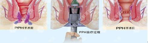 手术过程示意图