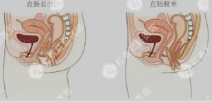直肠套叠与脱肛的区别