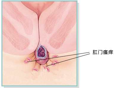 肛门瘙痒